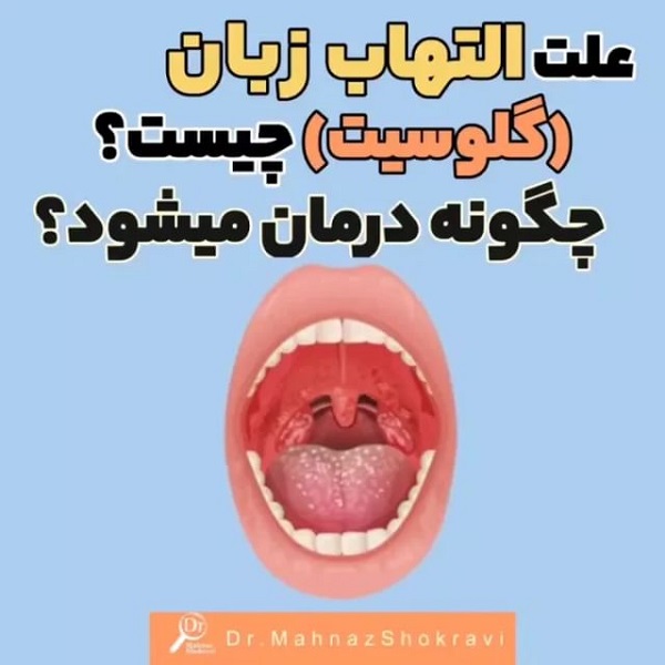 التهاب زبان(گلوسیت) چیست،مراقبت های پوستی ،جراحی بینی،جوش صورت،داروخانه دکتر مهناز شکروی،داروساز،mahnaz shokravi